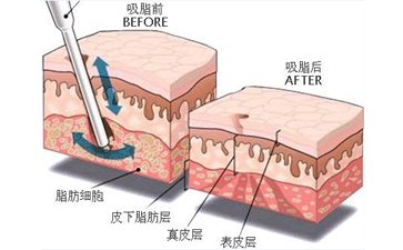 廣州吸脂瘦臉要多少錢(qián)