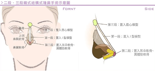 沈陽自體組織隆鼻那個效果比較好