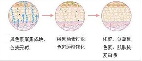 上海激光去斑會(huì)有后遺癥嗎