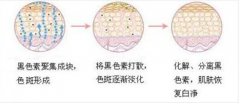 上海激光去斑會有后遺癥嗎