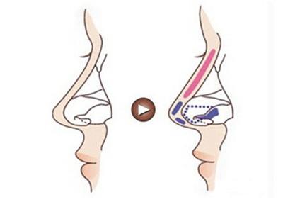 福州假體隆鼻失敗有哪些因素