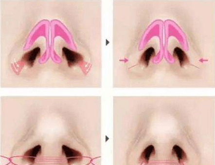 鼻孔整形