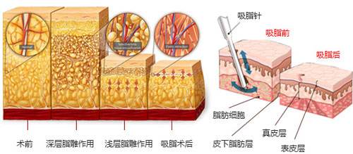 <a href='/xzjf/' target='_blank'><u>吸脂減肥</u></a>