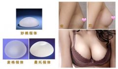 佛山假體隆胸后可以母乳嗎？