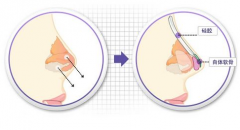 成都假體隆鼻手術(shù)的價(jià)格會(huì)很貴嗎
