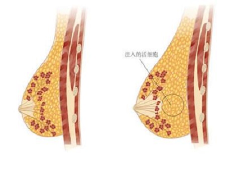 做自體脂肪豐胸手術(shù)