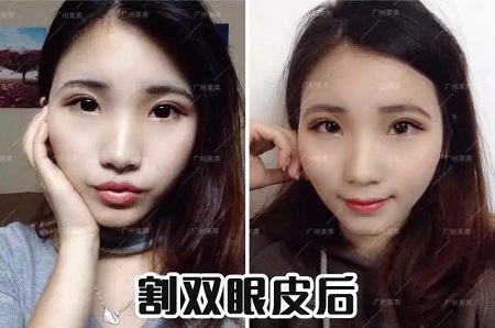 雙眼皮怎樣割，才能美出辨識度？