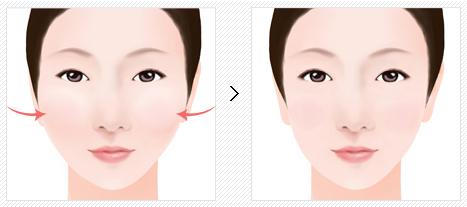 哪些因素影響改臉型手術(shù)的價(jià)格呢