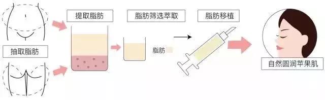 蘋果肌脂肪填充