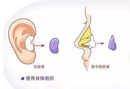 隆鼻材料