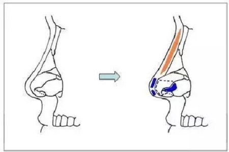 擔心鼻整形假體透光、發(fā)紅、移位？了解下自體軟骨