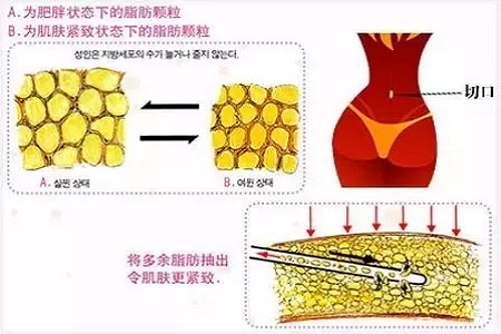 吸脂，怎樣做才算是剛剛好？