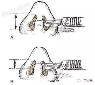 隆鼻手術(shù)切口在哪里？才能自然不留疤