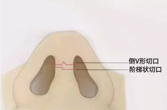 隆鼻手術(shù)切口在哪里？才能自然不留疤