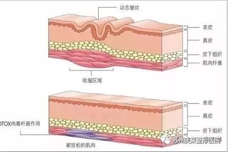 你無法用玻尿酸除掉所有皺紋！