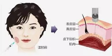 瘦臉會(huì)導(dǎo)致臉部凹陷松弛？