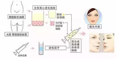 自體脂肪填充