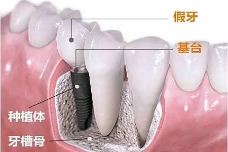 美萊牙齒矯正，讓你吃的香吃的好重享美味