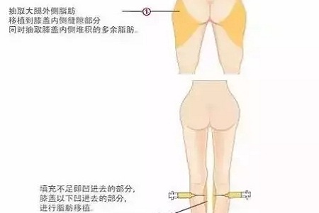 問(wèn)診室：你說(shuō)脂肪壓得你好累，殊不知它也可以是寶貝