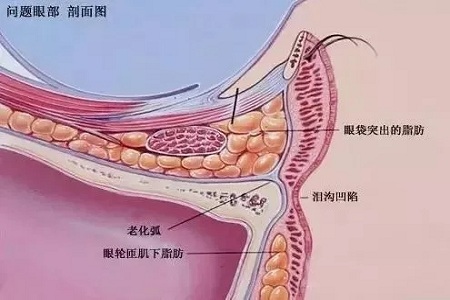 顯老淚溝，你還要任其放肆嗎？