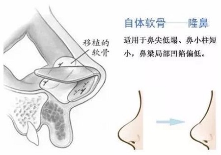 隆鼻