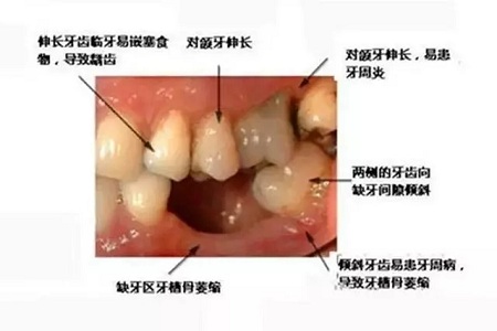 牙齒缺失時(shí)，選烤瓷牙還是那種？