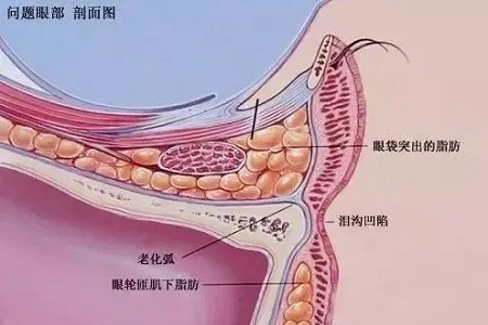 眼袋淚溝怎樣同時祛除