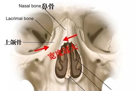 側面看鼻梁不矮,正面看鼻子卻很塌是什么原因？