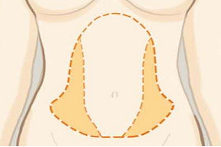 腰部吸脂手術(shù)