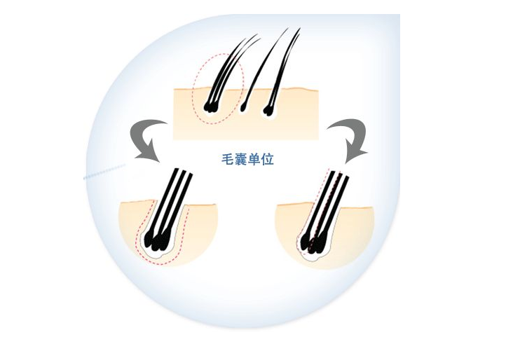 毛發(fā)種植