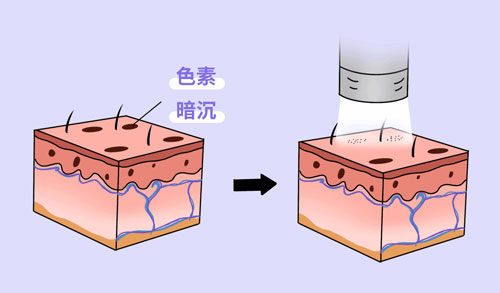 想要嫩膚，應該選擇做光電還是水光